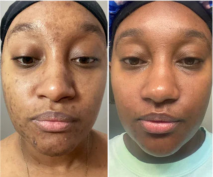Arbutin + TXA Skincare Cream