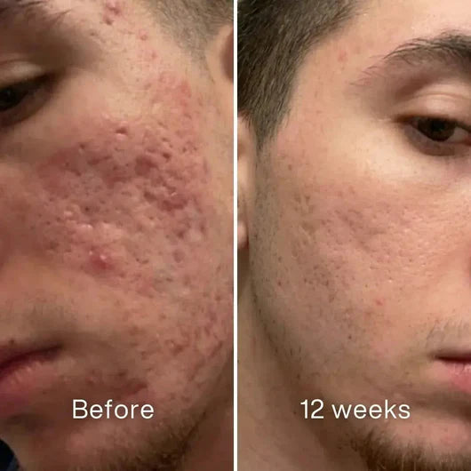 Highcote™ Acne Scar Repair Stick