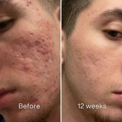 Highcote™ Acne Scar Repair Stick